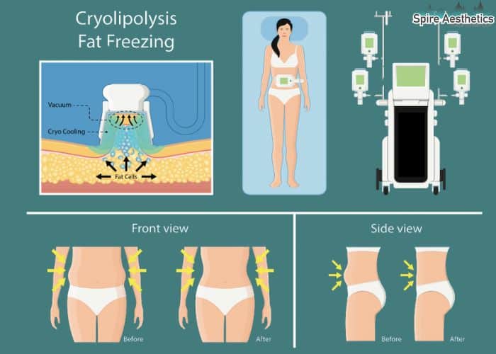 Image of diet and fat freezing combined for best results for Spire Aesthetics Poulton