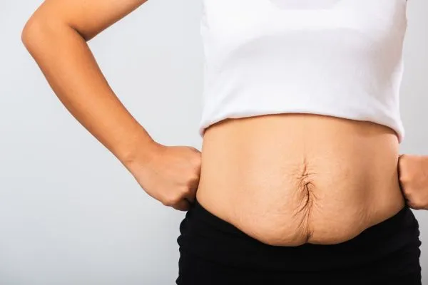 Image of a woman's stomach after weight loss with sagging skin following a gastric band Poulton
